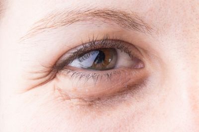5 процедури за тъмни кръгове под очите